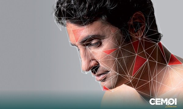 Podemos definir a disfunção temporomandibular (DTM) como uma série de sinais e sintomas resultantes de uma má relação entre a mandíbula e o osso temporal (crânio). Em alguns pacientes a DTM pode ser resultante de problemas provenientes dos músculos da mastigação, articulações temporomandibulares (atms) ou de ambos.