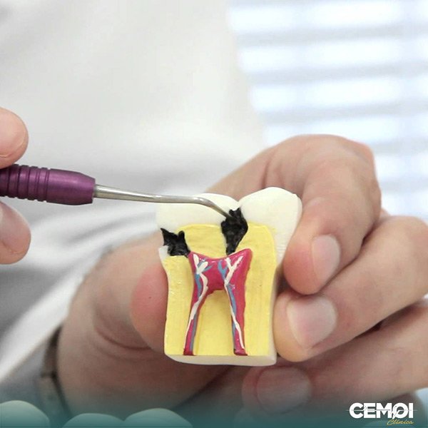 O que é endodontia e os riscos para saúde. A Endodontia é a especialidade da Odontologia que diagnostica e trata dos problemas da polpa dentária. Conheça nossa clínica odontológica em Brasília CEMOI